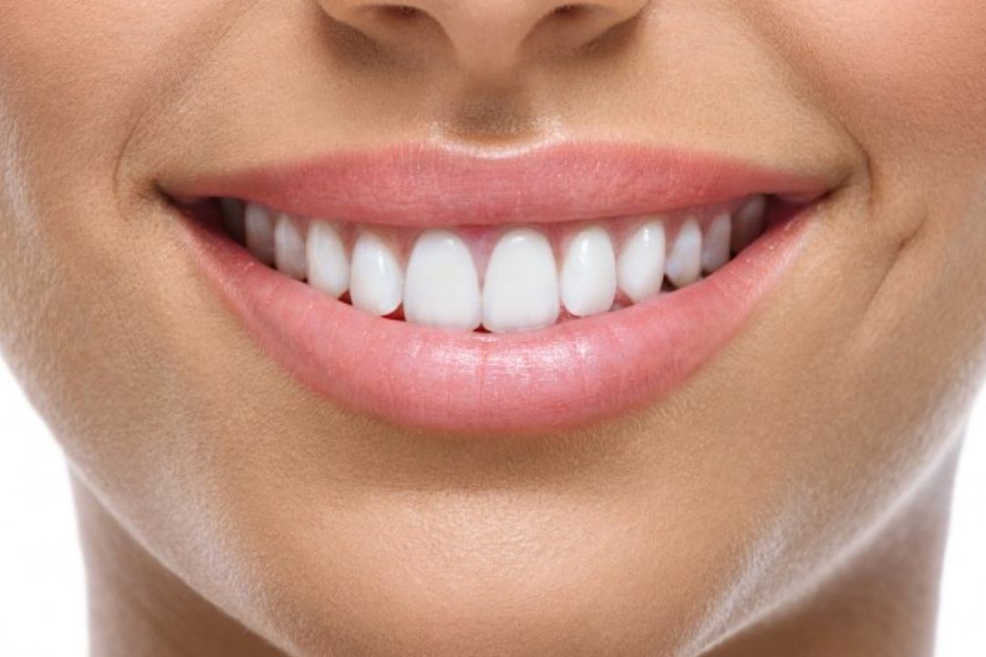 cropped CosmeticToothBonding